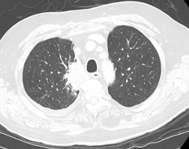 CT-Lungenkrebs-Screening